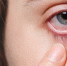 EID: паразит Philophthalmus от галапагосских львов попал в глаз женщины - ProGorodSamara.Ru